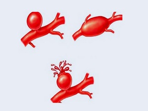 Aort damarı yırtığı nedir?