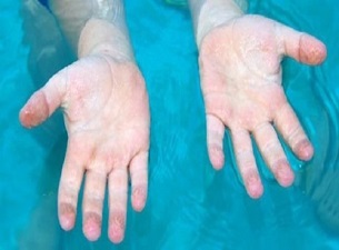 Parmakların suda buruşmasının gerçek nedeni