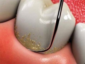 Diş taşı temizliğinin diş ve diş eti sağlığına zararı yok