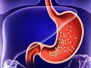 Tedavi edilmeyen gastrit, mide kanserine yol açabilir