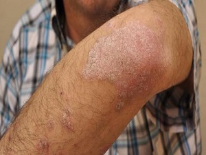 Sedef hastalığı için umut ışığı