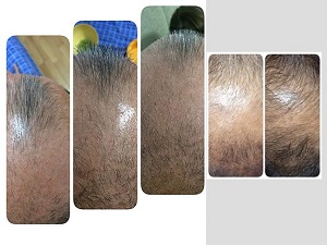 Saç dökülmesine nanoteknoloji ile çözüm