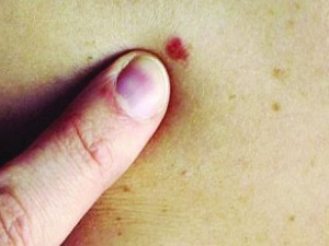 Kırmızı ben deyip geçmeyin!