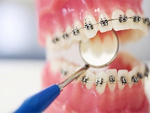 Ortodontik tedavi, diş çürüğüne yol açar mı?