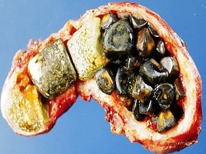 Safra taşı ölümcül olabilir