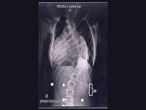 Her 100 gençten 3’ünde omurga eğriliği var