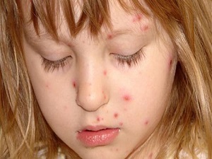 'Su çiçeği' çıkaran çocuğa aspirin vermeyin!