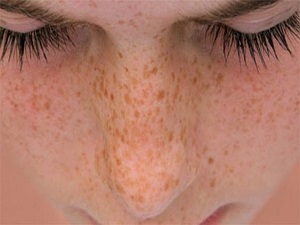 Mor ötesi ışın veren elektrik lambaları cilt kanseri yapıyor