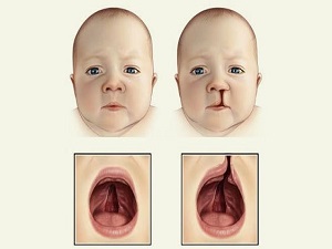 Yılda bin 500 çocuk dudak-damak yarıklı doğuyor