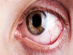 Göz enfeksiyonlarına karşı hijyene dikkat edin