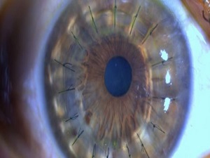 'Yerli malı' kornea dönemi