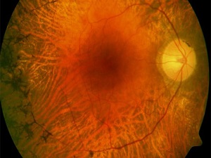 Göz hastalığı 'Tavuk Karası'nda kök hücre başarısı