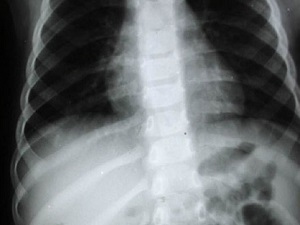 E-Burun yöntemi Türkiye'de de uygulanacak