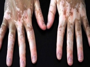 Beyazlama hastalığı ile baş etmenin yolları