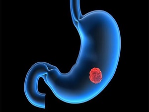 Mide yanması, kanser belirtisi olabilir