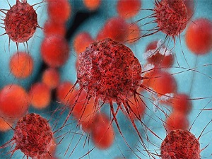 Kanserin yeni düşmanı: Radyoembolizasyon