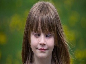 Şaşılık cerrahi müdahaleyle düzeltilebilir