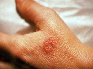 Duygusal sorunlar bu hastalığı tetikliyor