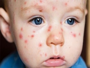 GDO, çocuklarda alerjiyi tetikliyor!