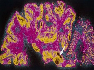 Parkinson hastalığına erken teşhis umudu