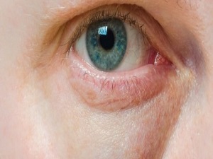 Göz altı torbaları yaşlı gösteriyor