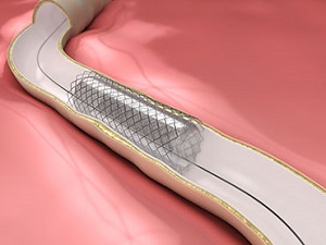 Stent uygulamasıyla ilgili merak edilenler