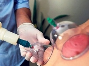 Hacamatla fıtık ve kanser tedavisi mümkün!