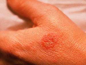 Egzama, eklem iltihabı ve saçkırana "göbek bağıyla" çözüm