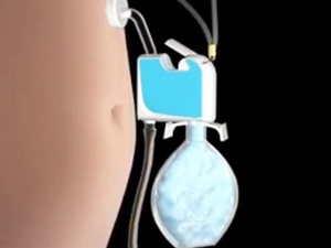 Zayıflamak için mide yıkama cihazı