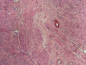 Her dört kadından birinde ortaya çıkıyor