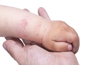 Gece kaşıntılarına dikkat