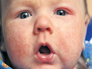 Egzamalı çocukların yüzde 40'ı alerjik!