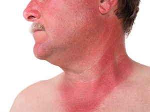 Yanıklara diş macunu ve yoğurt sürmeyin!