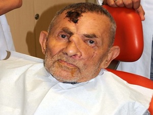 Protez monteli yeni yüz