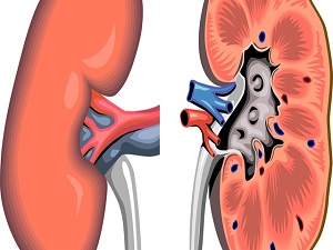 Böbrek hastaları oruç tutarken dikkatli olmalı