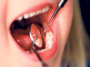 Kronik stres diş etlerini de vuruyor!