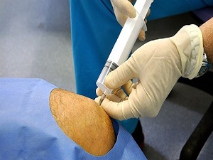 Eklem ağrısı çekenlere müjde