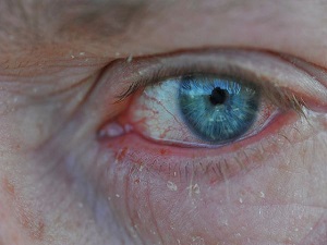 Göz alerjisine dikkat