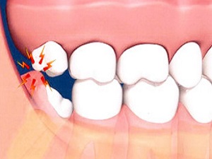 20 yaş dişleri kabusunuz olmasın