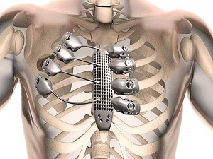 Göğüs kafesinde titanyum devri