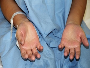 El terlemesinden bakın nasıl kurtuldu?