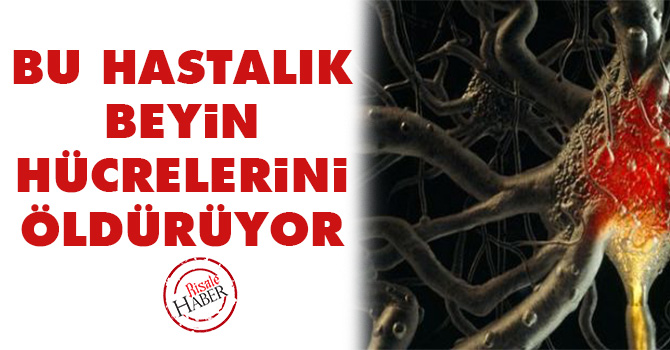 Bu hastalık beyin hücrelerini öldürüyor!