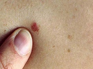 'Benlerin alınması kansere yol açmaz'