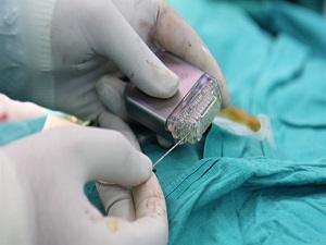 Beyin pili Parkinson hastalarında titremeyi önlüyor