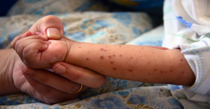 Çocuklarda el ayak ağız hastalığına dikkat