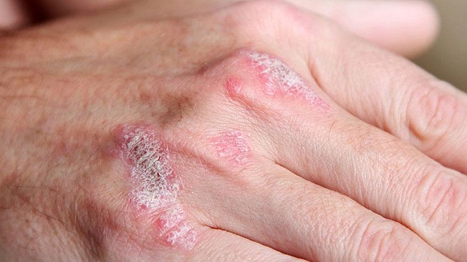 Boğaz enfeksiyonu sedef ataklarına yol açabilir