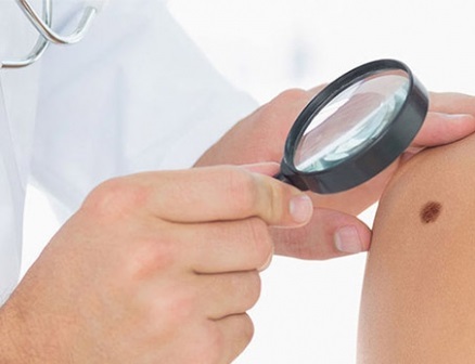 Deri kanseri kahverengi benlerle geliyor