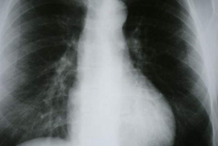 'Hastaların yüzde 90'ı KOAH olduğunun farkında değil'