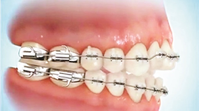 Ortodonti tedavisi