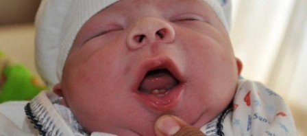 Dudak ve damak yarığı, anne karnında teşhis edilmeli